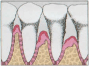 Advanced Periodontitis